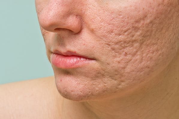 Eliminar cicatrices y marcas del acné