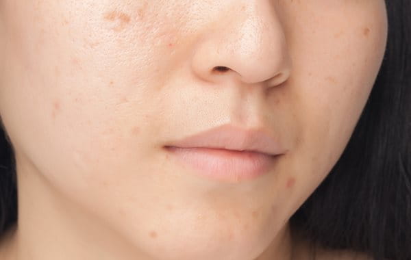 El acné puede causar cicatrices y dejar marcas.