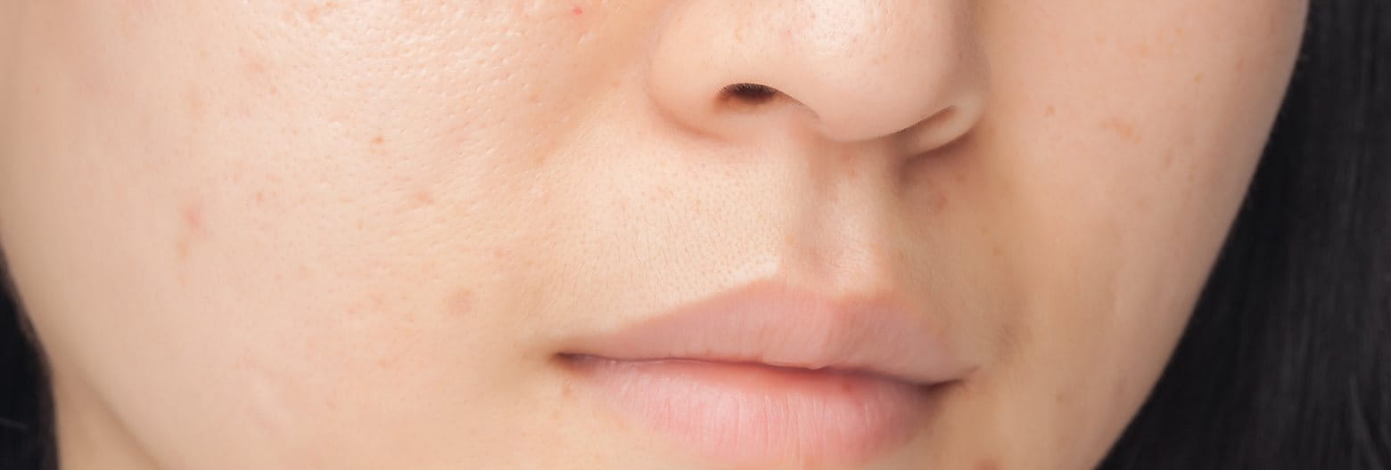 A targeted skincare routine can help remove pimple marks