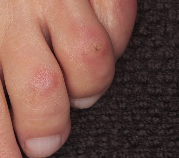 Painful hard skin on foot online