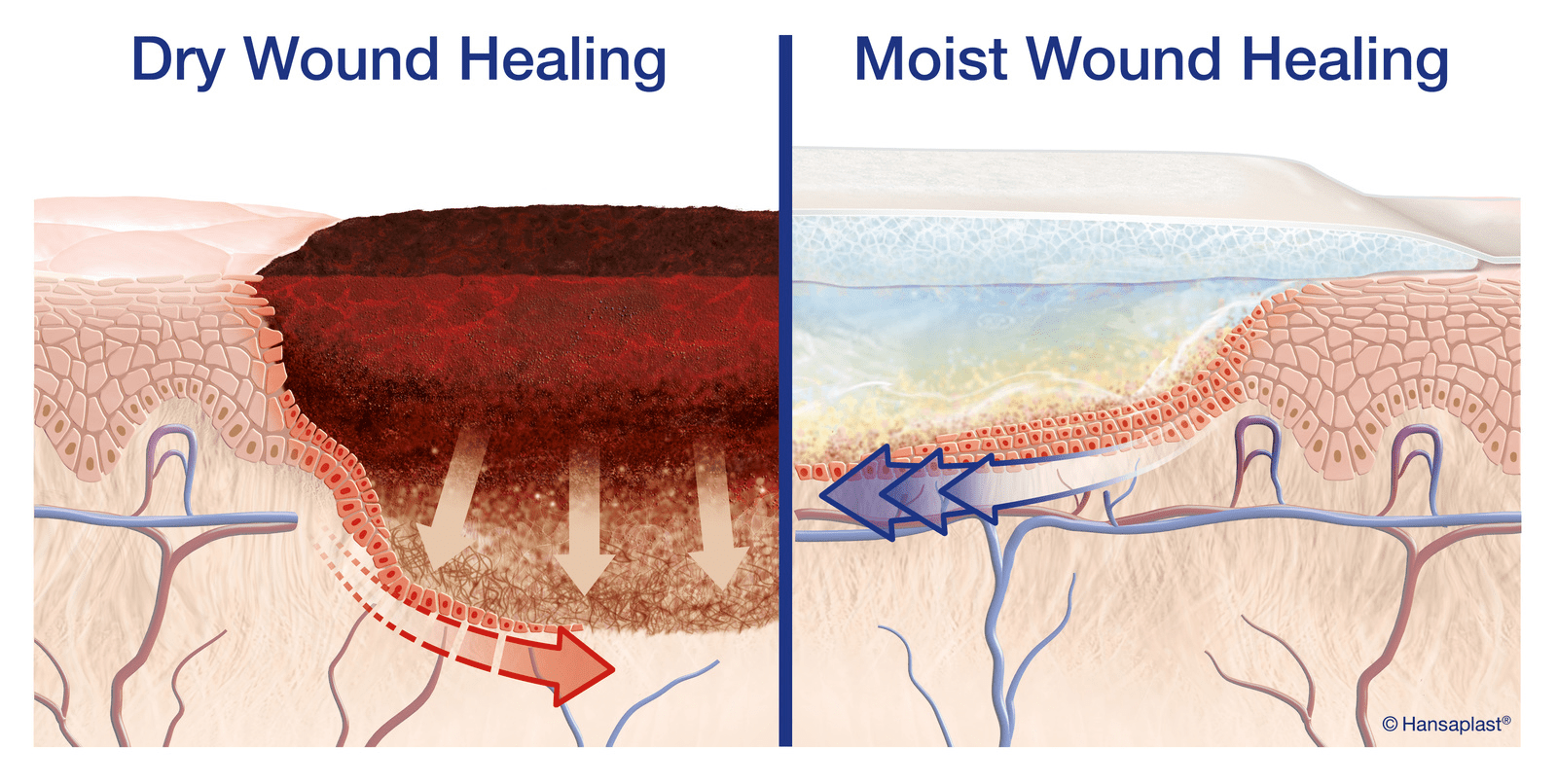 Diagram of dry wound healing versus moist wound healing