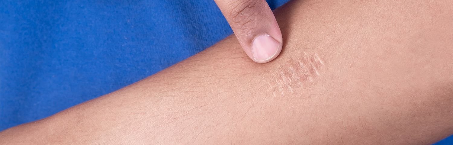 Finger zeigt auf Narbe auf dem Arm