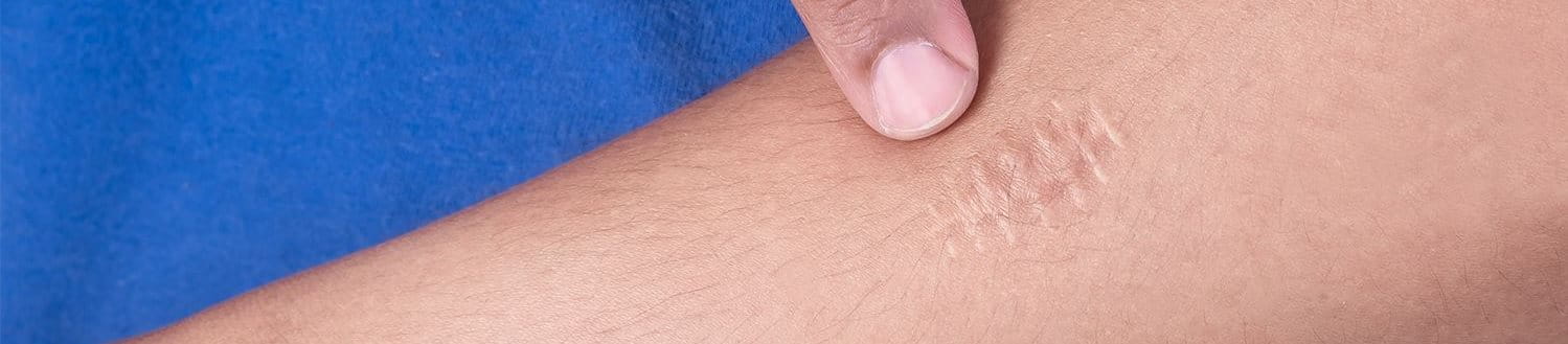 Finger zeigt auf Narbe auf dem Arm