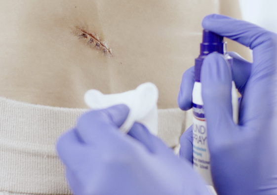 Nettoyer soigneusement une plaie chirurgicale.