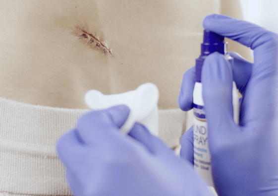 Nettoyer soigneusement une plaie chirurgicale.