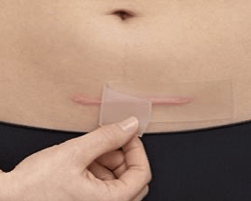 Protéger une plaie chirurgicale à l’aide d’un gros pansement.