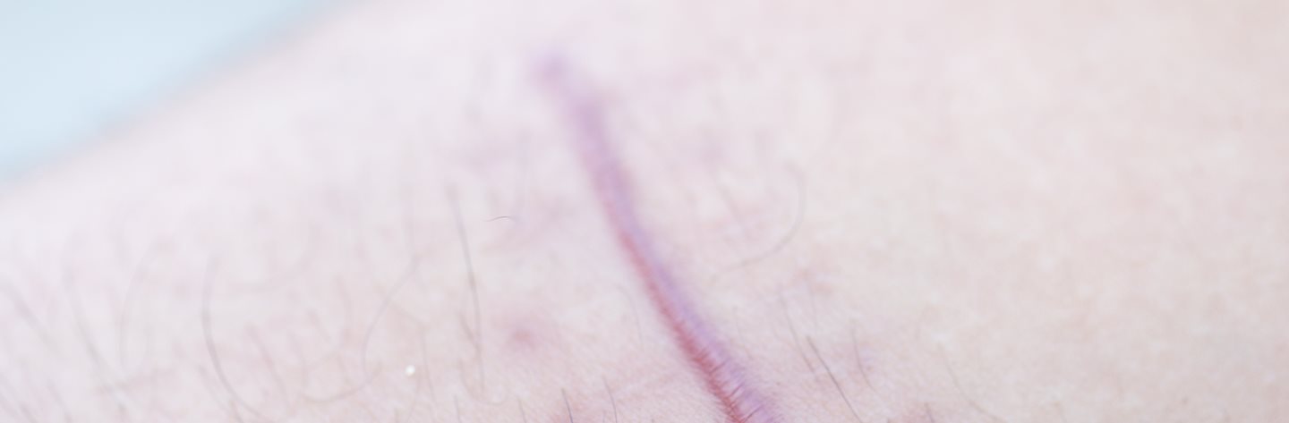 Nahaufnahme von Narbe