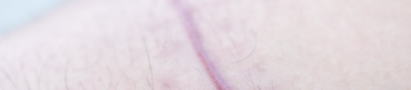 Nahaufnahme von Narbe