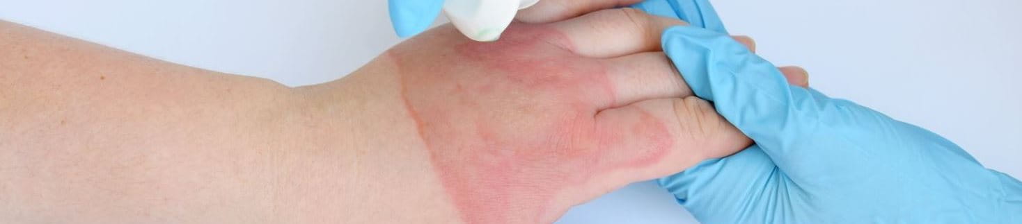 Verbrennung zweiten Grades an der Hand behandeln