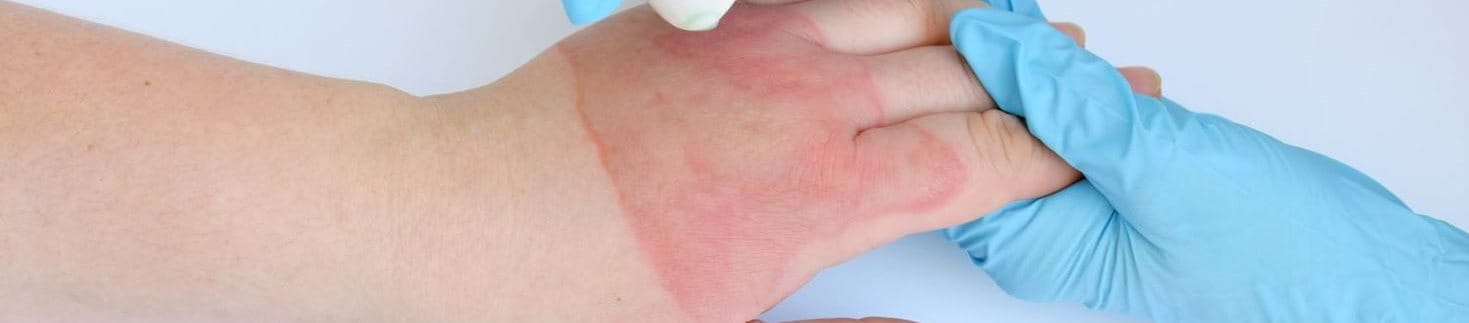 Verbrennung zweiten Grades an der Hand behandeln