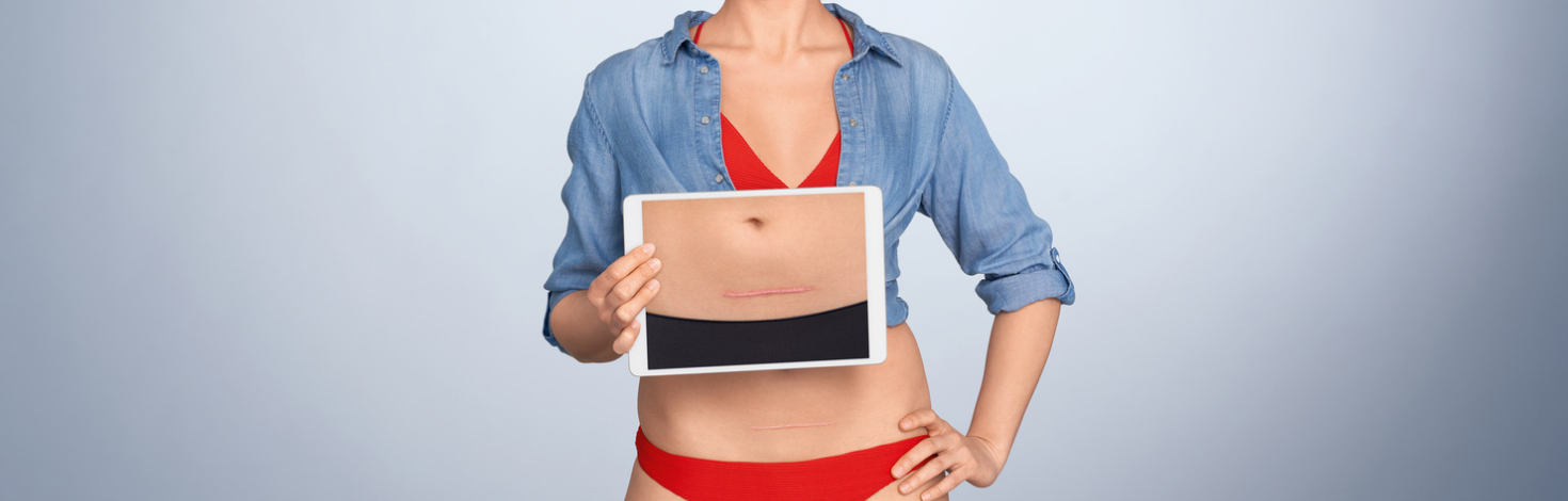 Image showing effectiveness of Elastoplast Scar Reducer Patches