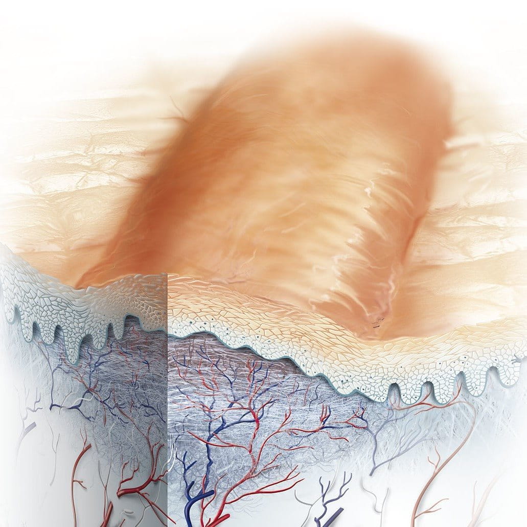 Medical illustration of a hypertrophic scar