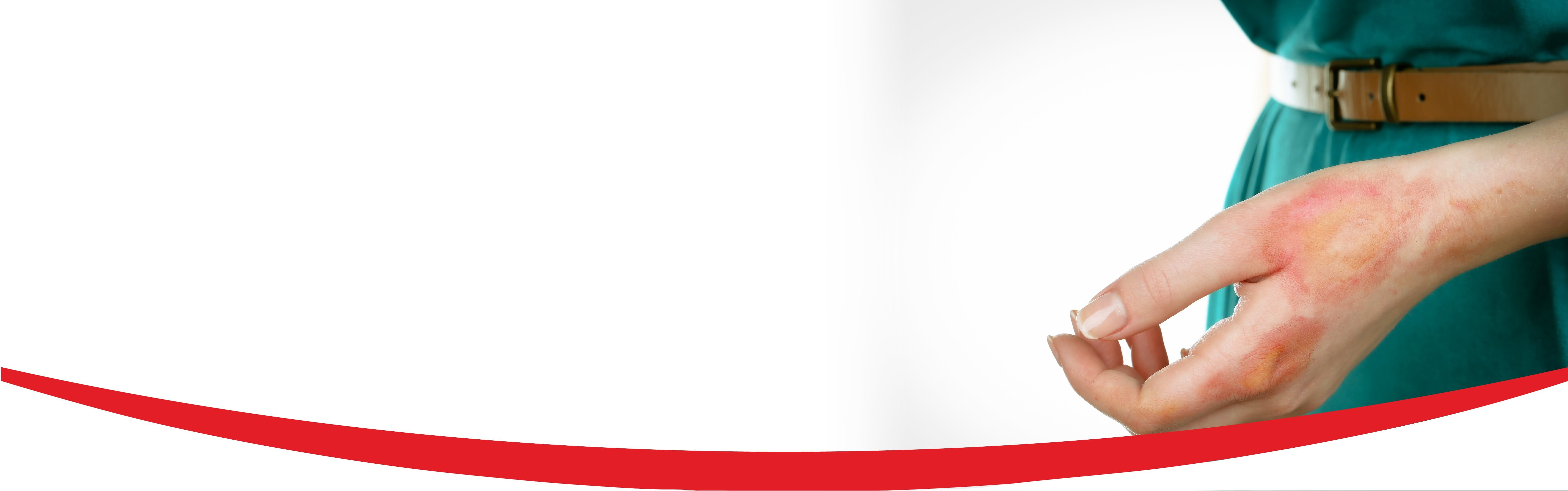 Merawat tangan kena uap panas