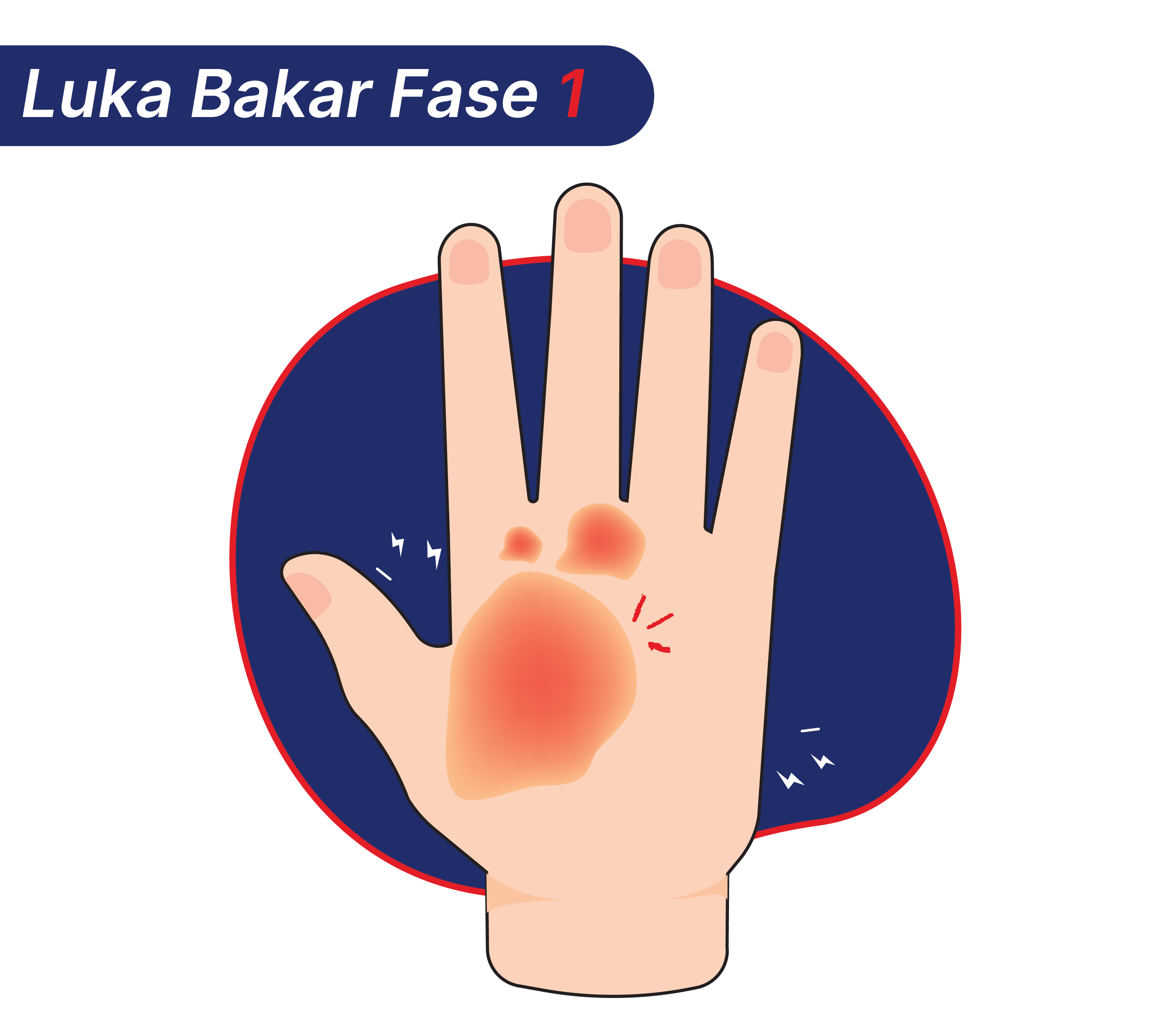 Luka bakar fase 1 yang bisa terjadi setelah tangan kena uap panas