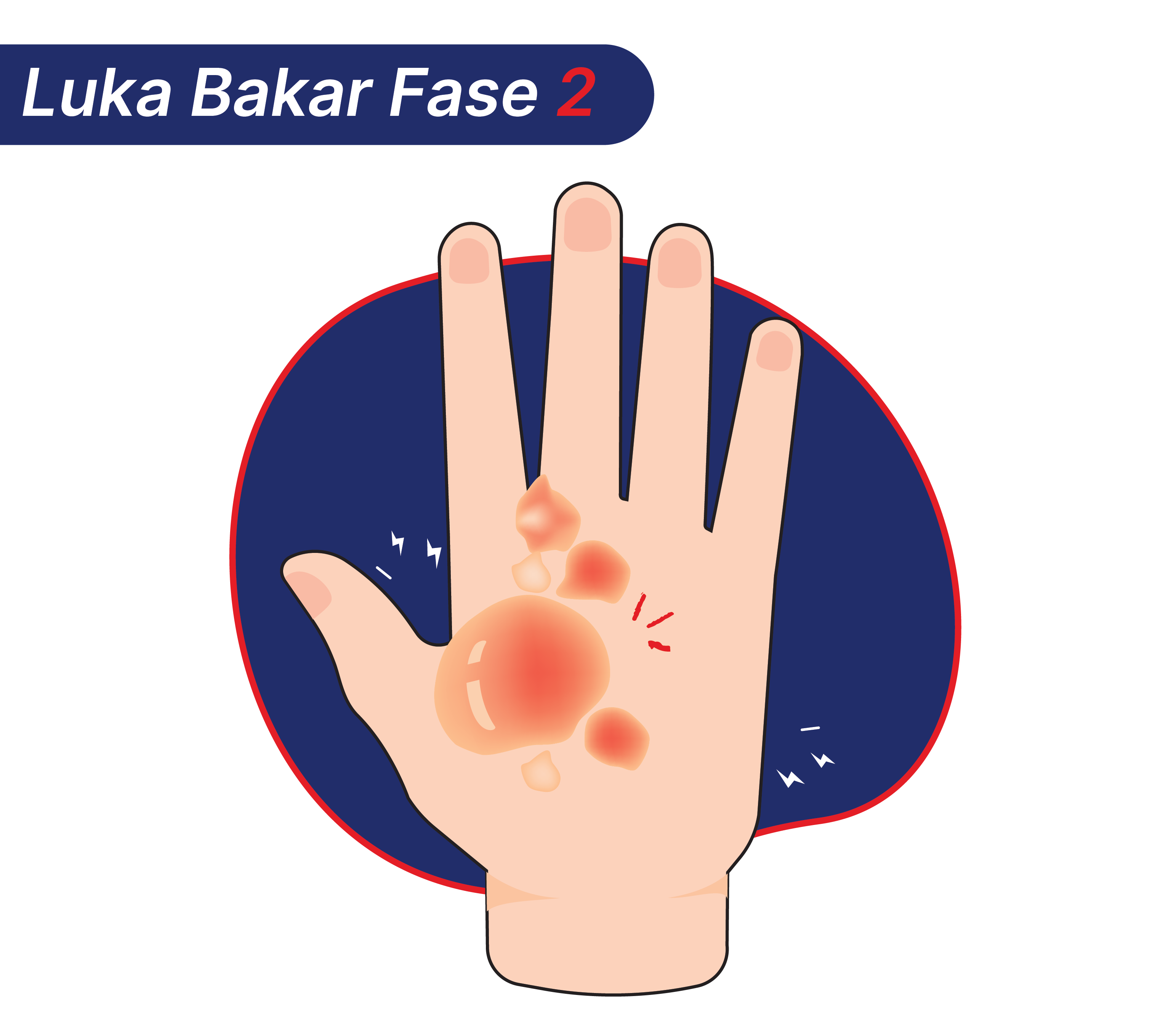 Luka bakar fase 2 yang mungkin terjadi setelah tangan kena uap panas