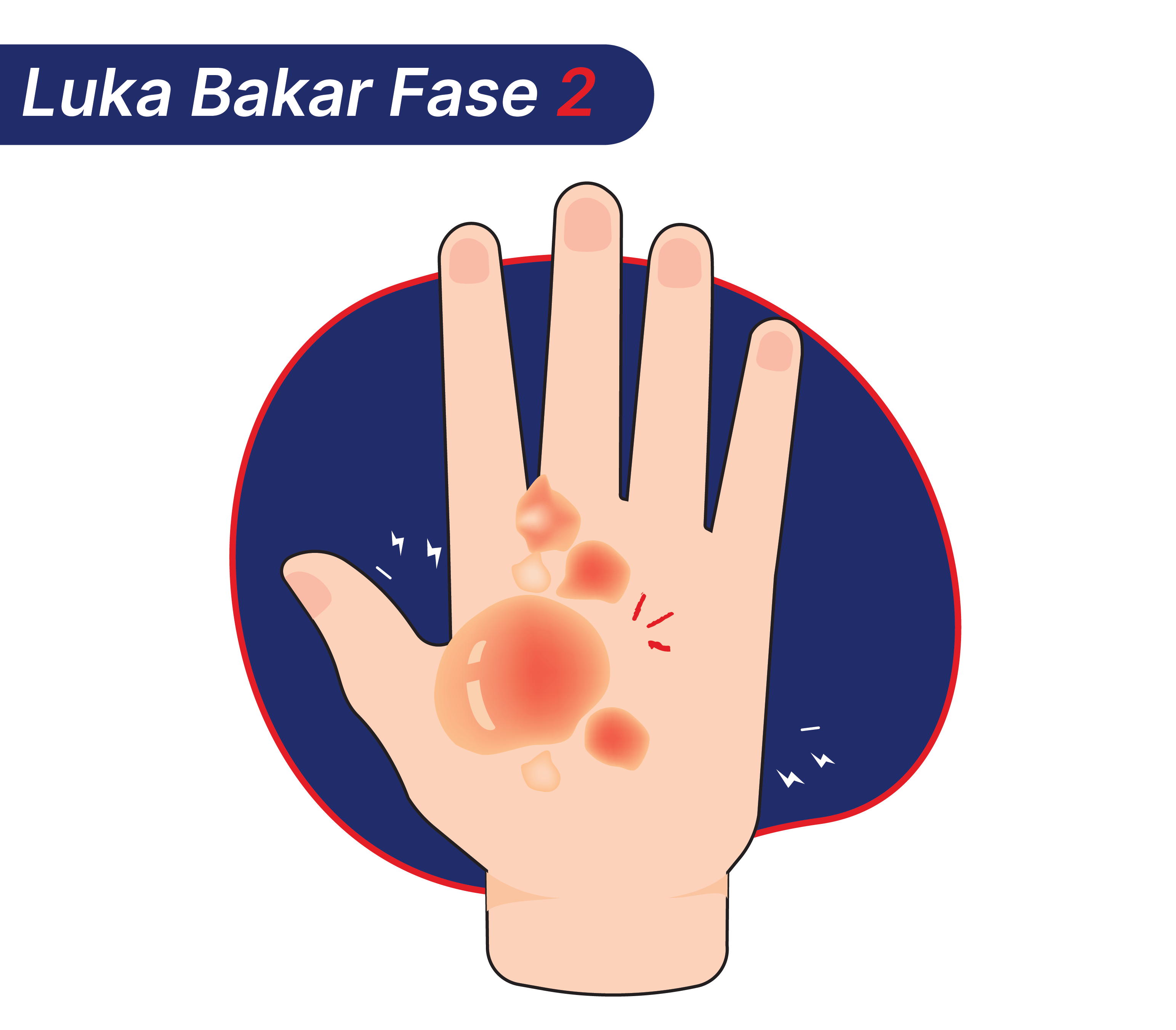 Luka bakar fase 2 yang mungkin terjadi setelah tangan kena uap panas