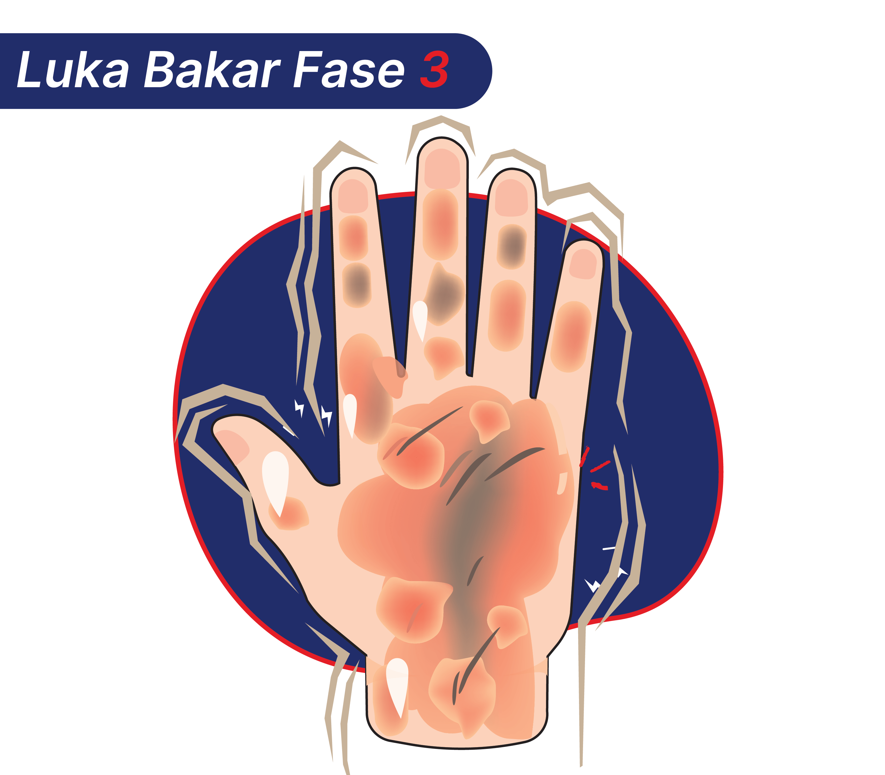 Gambaran luka bakar fase 3 yang bisa terjadi setelah tangan kena uap panas