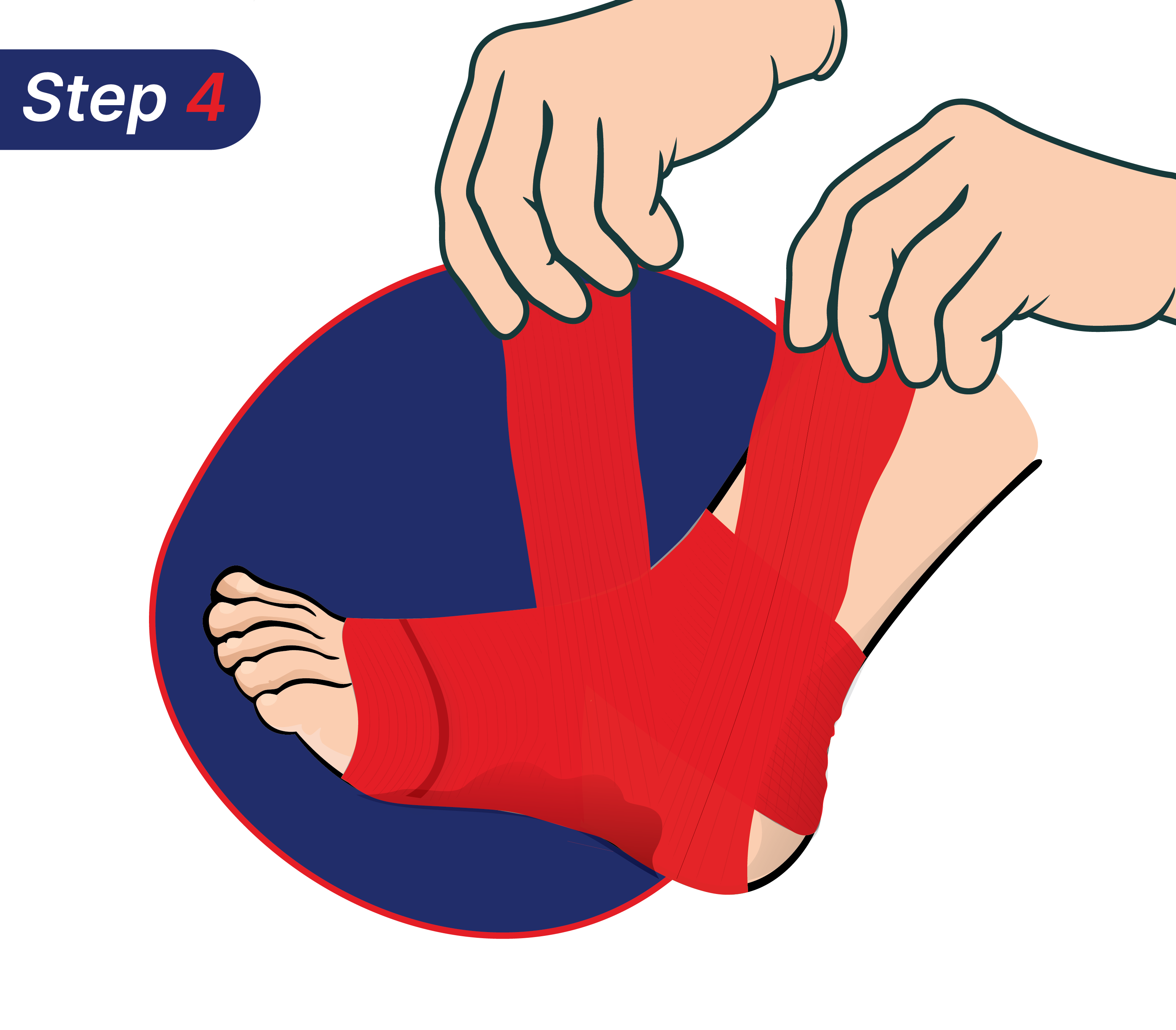 Cara mengatasi kaki terkilir sendiri.