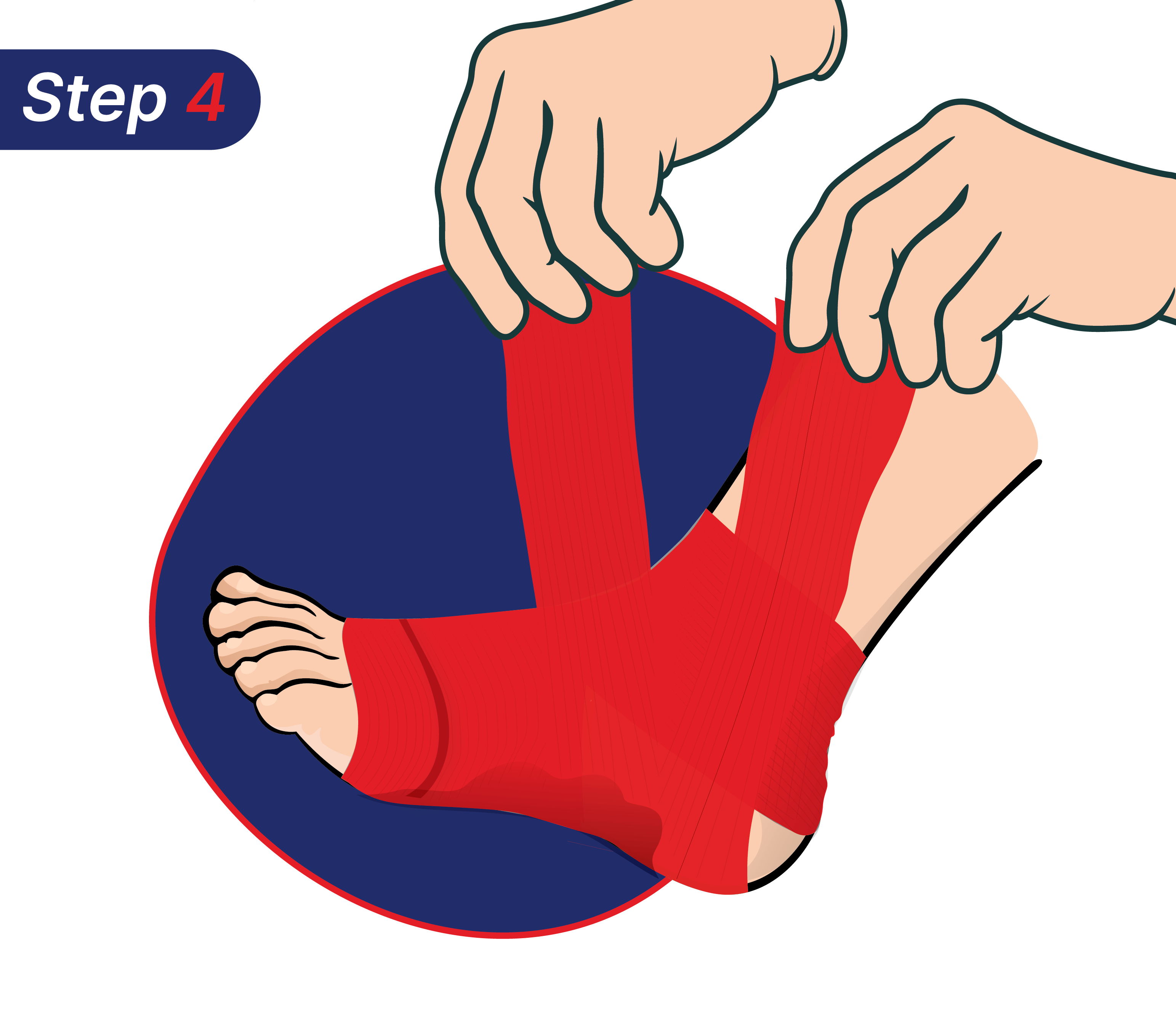 Cara mengatasi kaki terkilir sendiri.