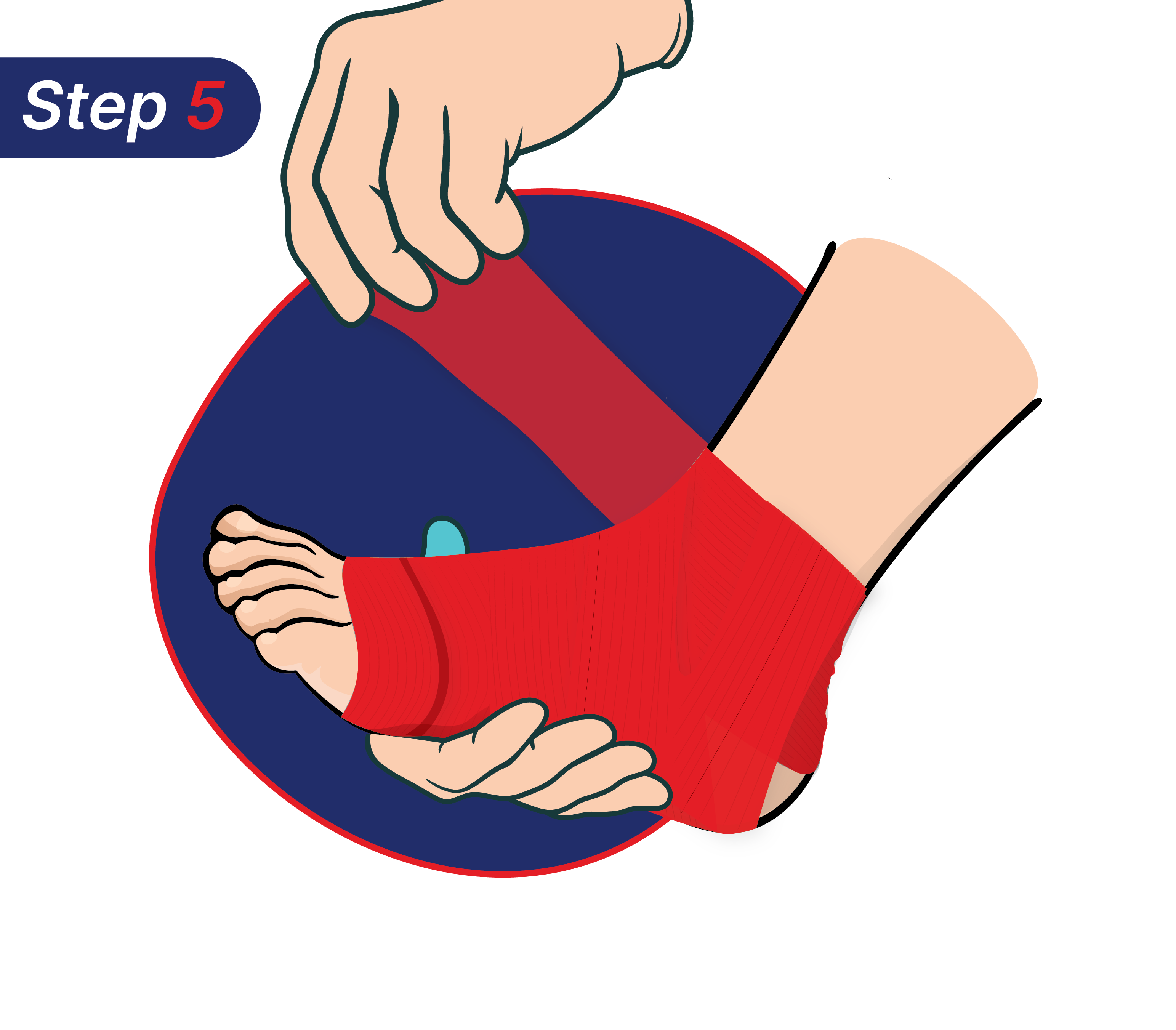 Cara mengatasi kaki terkilir sendiri.