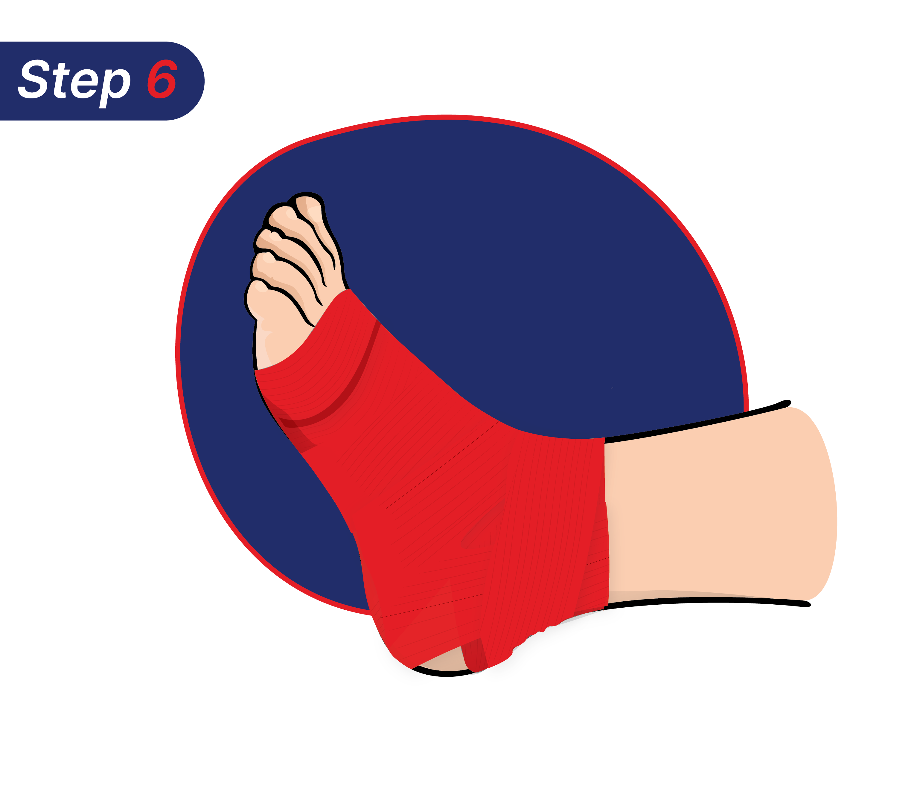 Cara mengatasi kaki terkilir dengan benar.