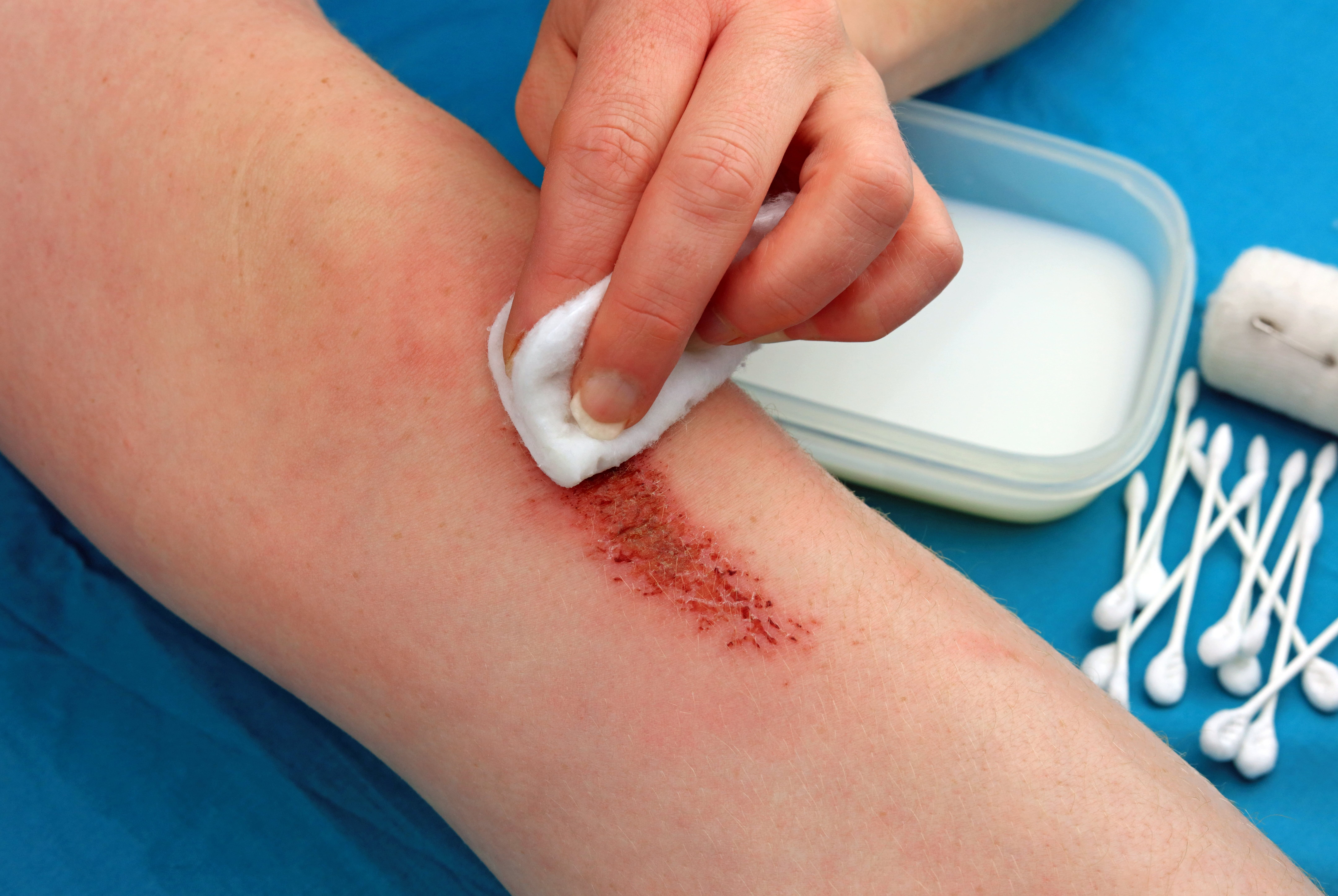 Cara yang perlu dilakukan untuk mencegah infeksi luka.