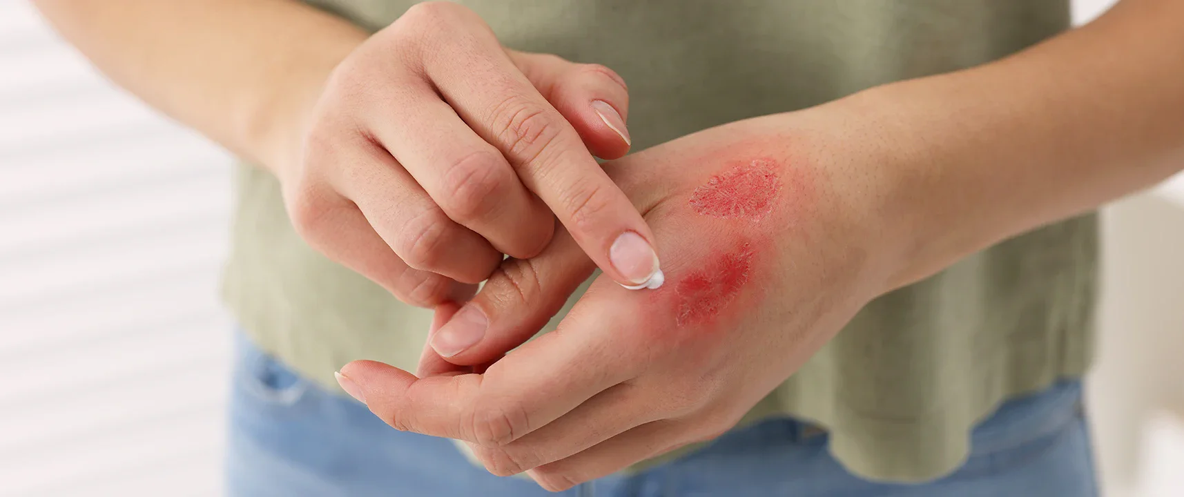 Cara merawat luka bakar agar lekas sembuh.