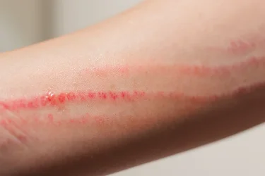 Cara mengatasi luka gores pada bagian tubuh.