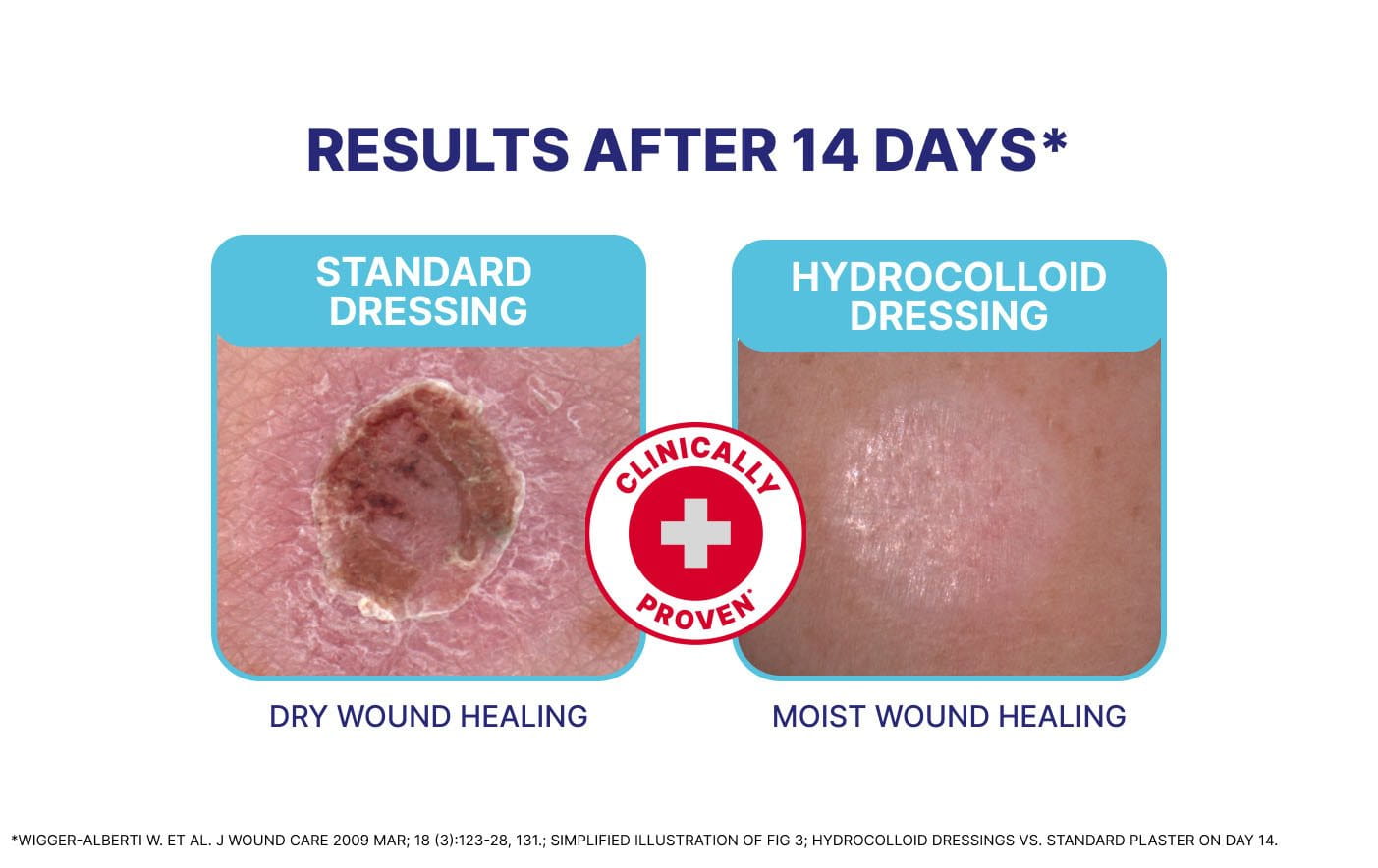 Before and after images comparing 14-day results of wound care using standard dressing vs hydrocolloid dressing for dry wound healing and moist wound healing.
