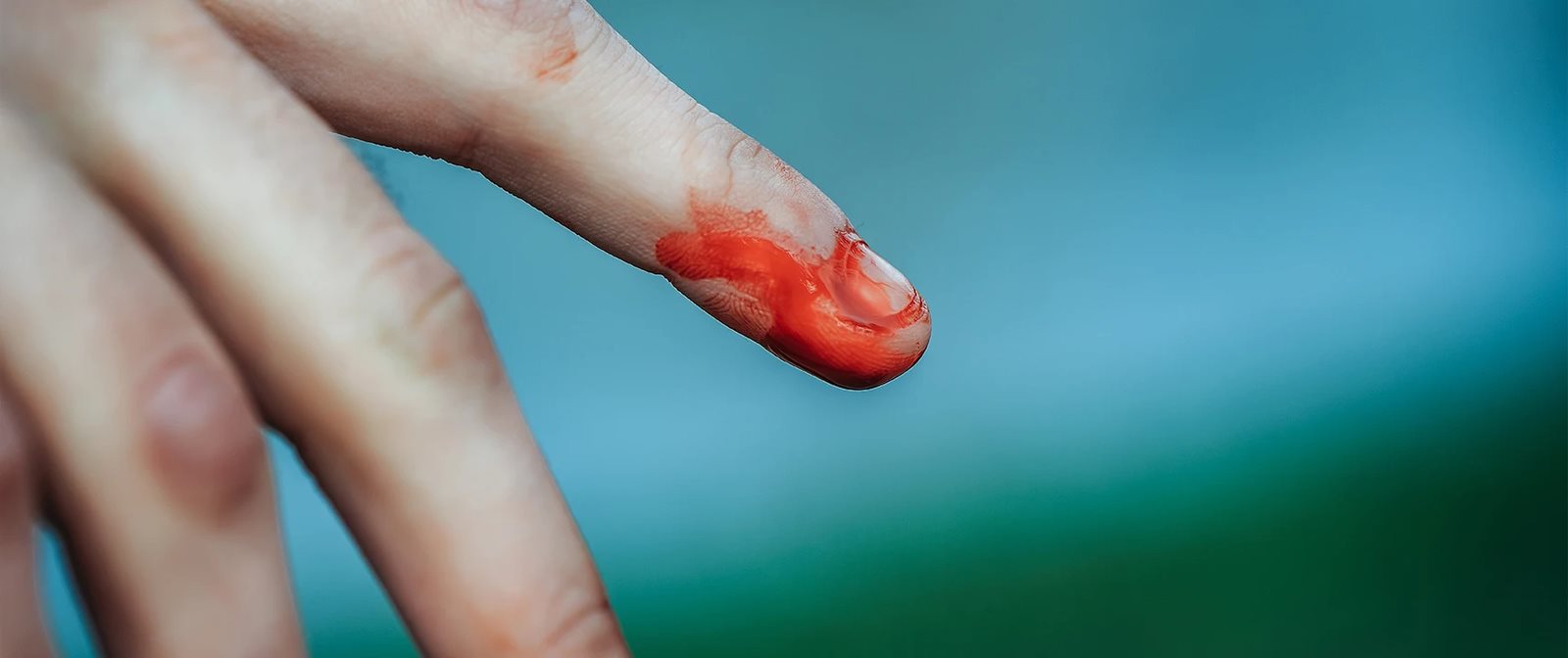 Tangan yang terluka harus segera disembuhkan