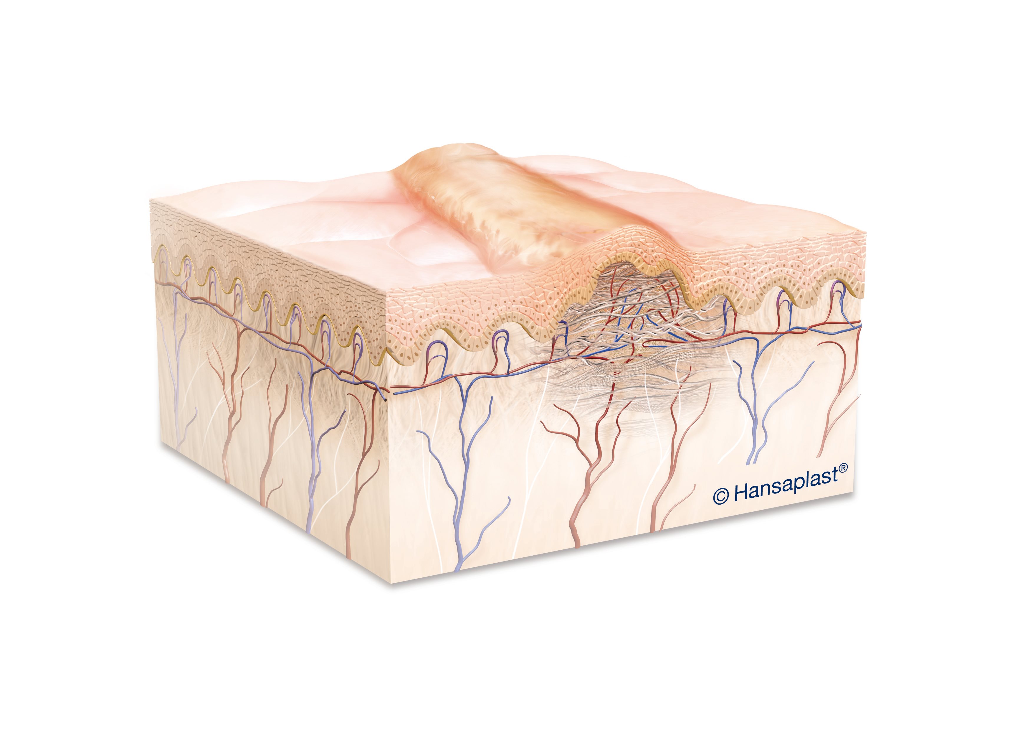 Illustrazione scientifica di una cicatrice ipertrofica
