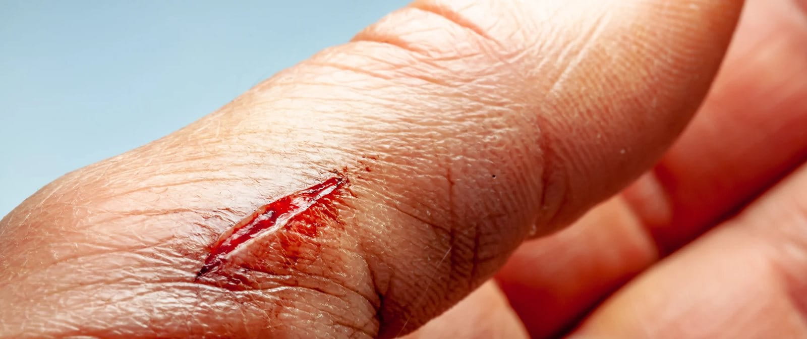 Cara membalut luka dengan kasa agar cepat sembuh.