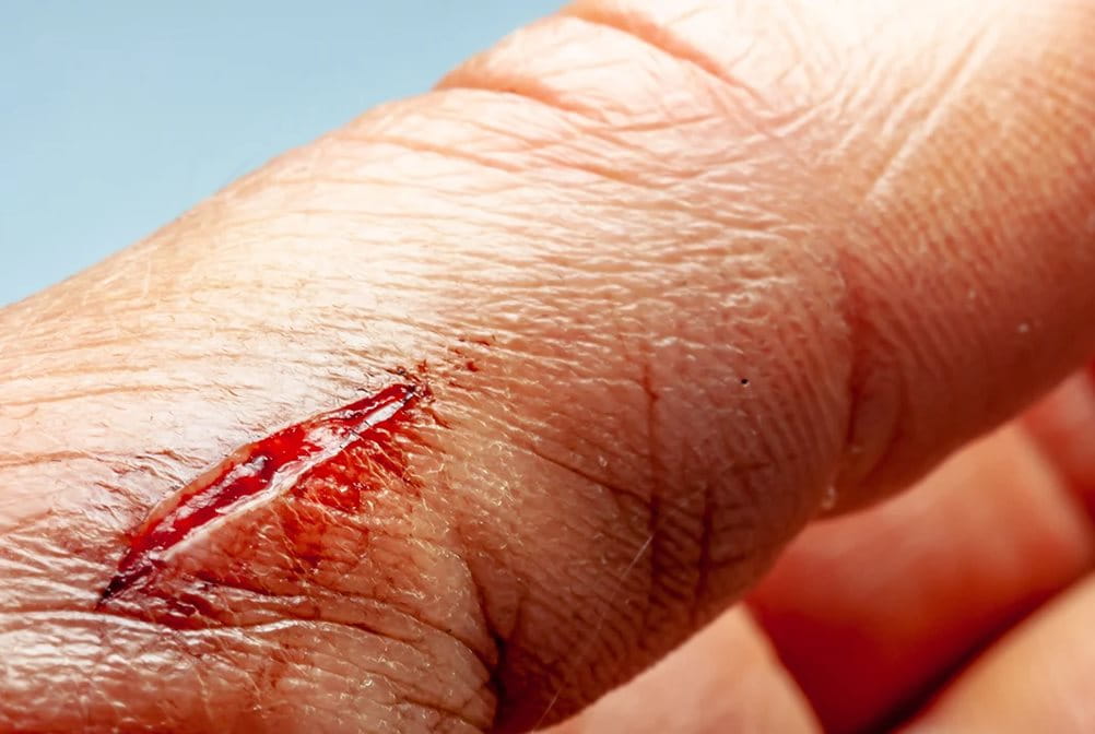 Cara membalut luka dengan kasa agar cepat sembuh.