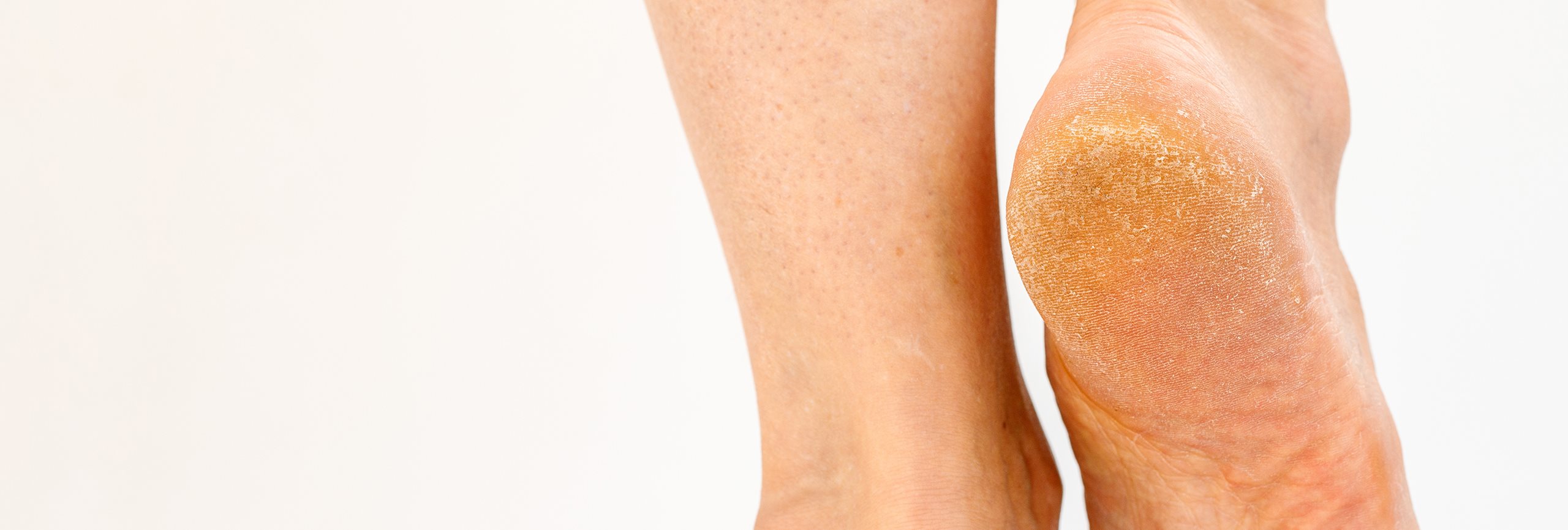 Problemas comunes de los pies