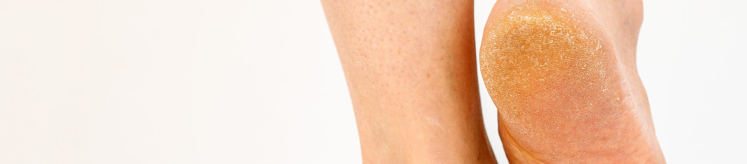 Problemas comunes de los pies