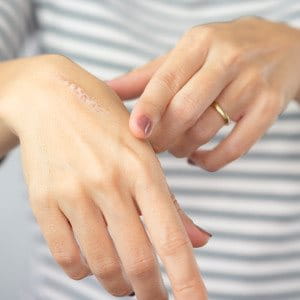 Tratamiento para cicatrices