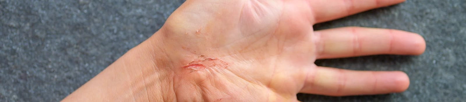 Luka gores dapat terjadi di mana saja, termasuk di rumah.