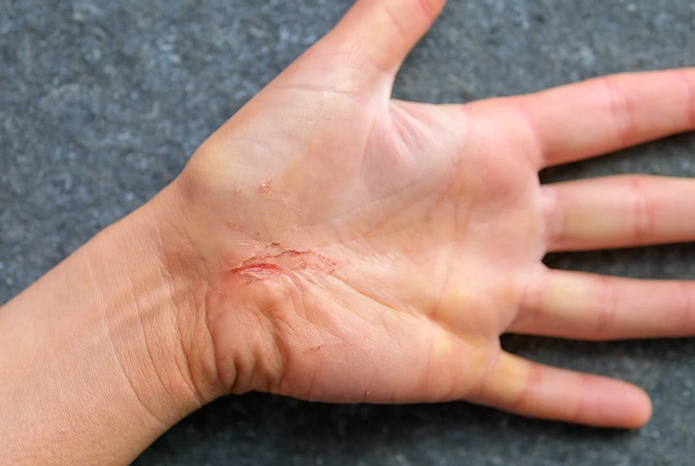 Luka gores dapat terjadi di mana saja, termasuk di rumah