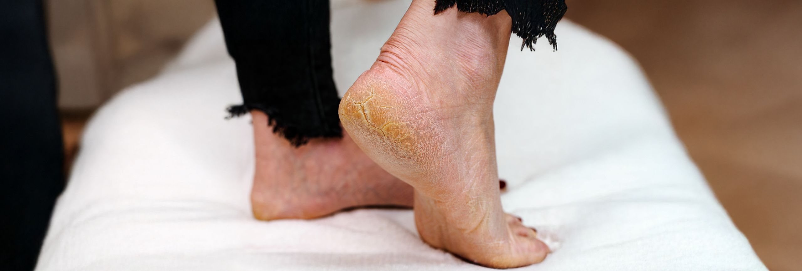 piel seca y callos en los pies