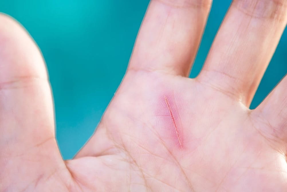 Luka yang cepat ditangani akan sembuh dengan lebih baik