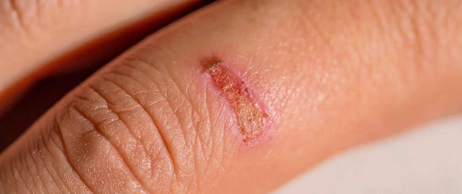 Luka yang dalam proses penyembuhan