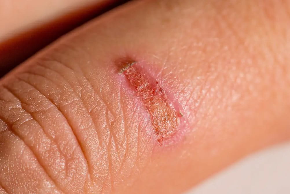 Luka yang dalam proses penyembuhan