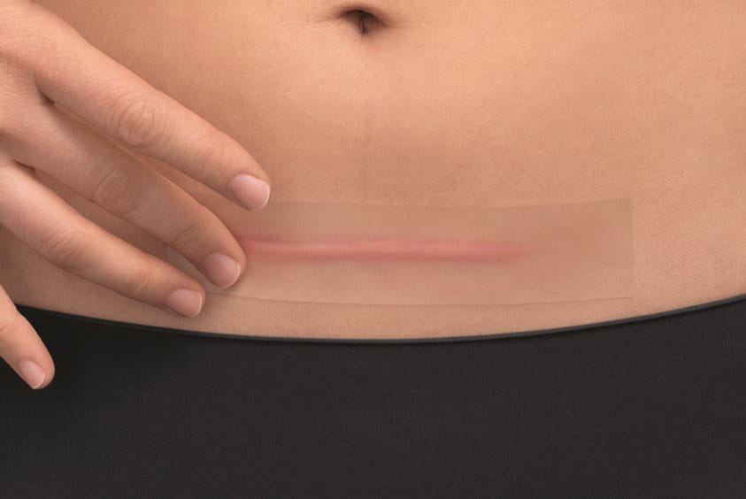 Close-up shot of a person touching a horizontal c-section scar on their lower belly