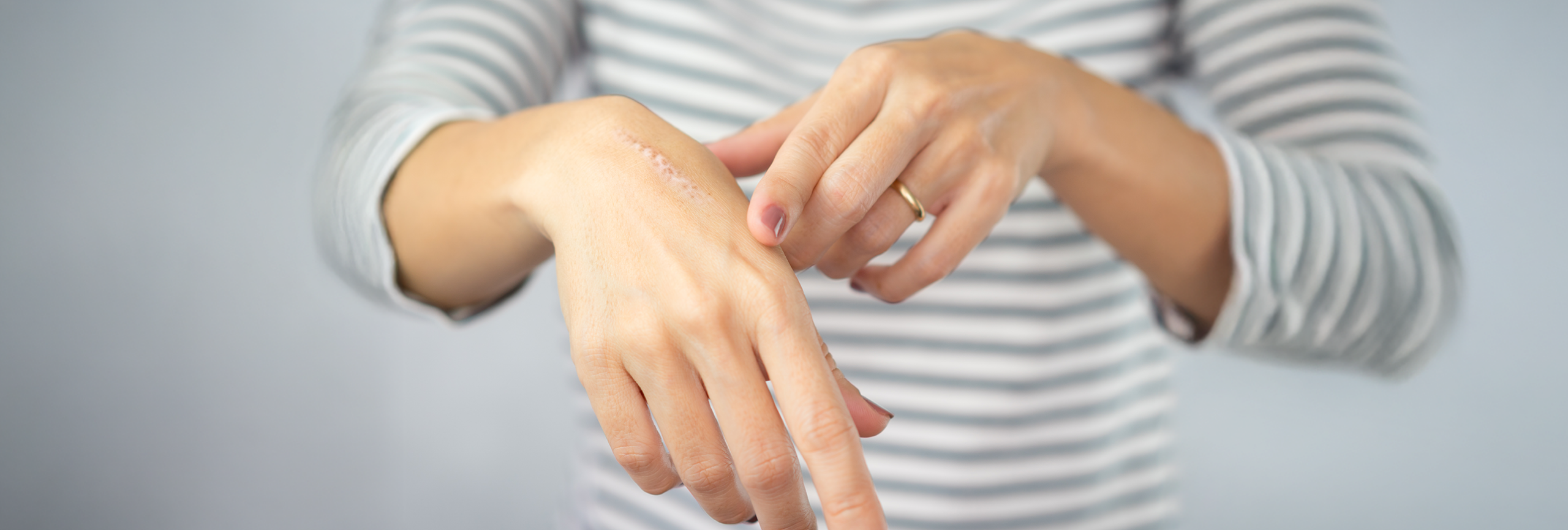 Tratamiento para cicatrices