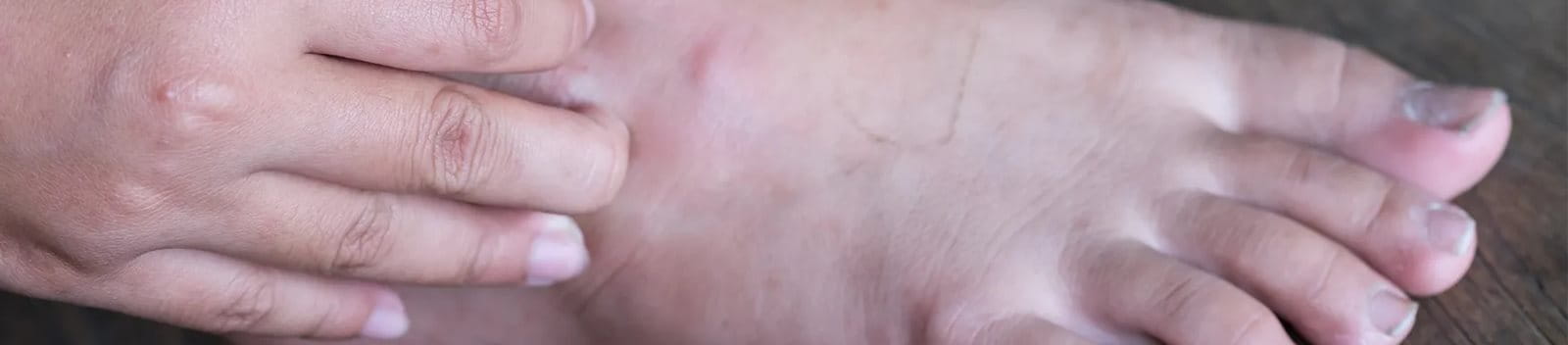 Perawatan luka diabetes untuk kaki