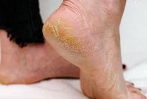 piel seca y callos en los pies