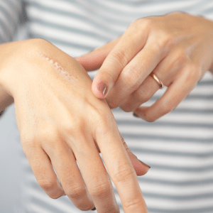 Tratamiento para cicatrices