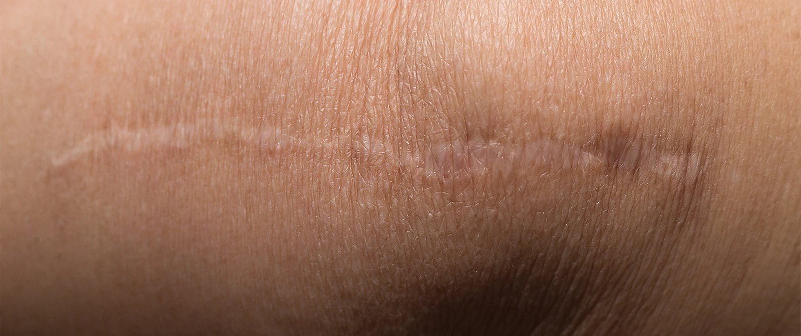 bekas luka di tangan