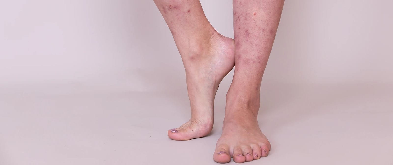 Bekas koreng di kaki sangat mengganggu aktivitas Anda