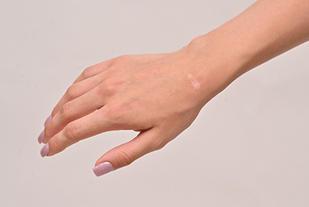 Tratamiento para cicatrizes Curitas®